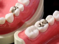 金銀パラジウム合金