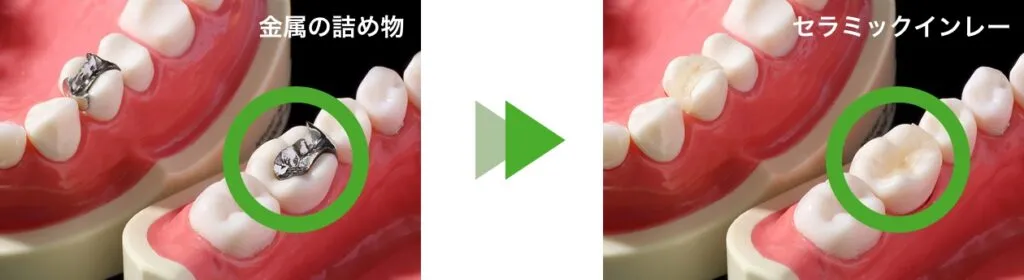 セラミックスインレー（詰め物）