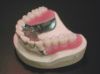 メタル床義歯