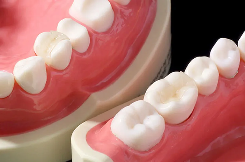 詰め物・かぶせ物の種類