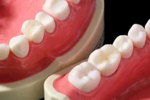 ②e.max インレー（詰め物）