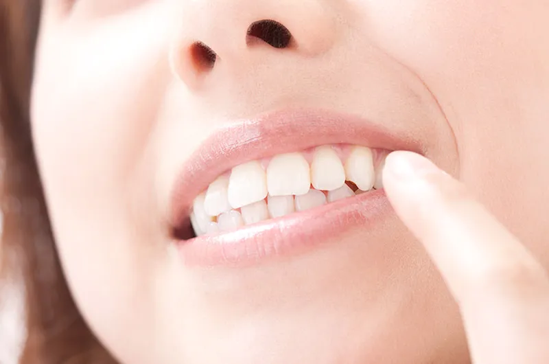 ホワイトニングとは