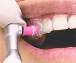 説明と歯の表面のクリーニング<