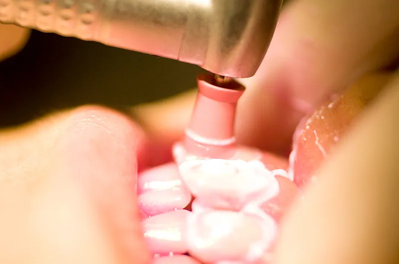 オフィスホワイトニング