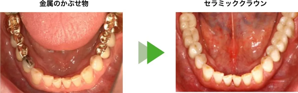 セラミックスクラウン（かぶせ物）