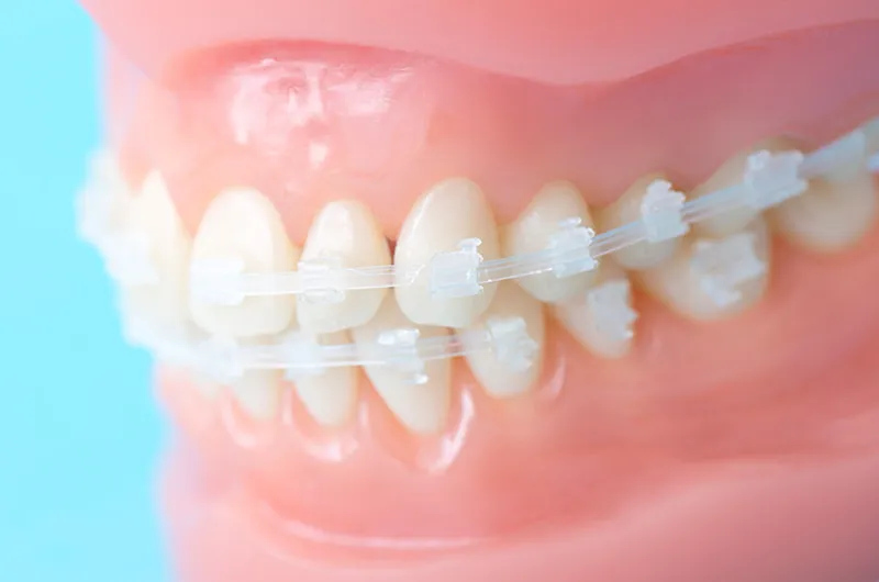 矯正治療の準備・矯正装置の装着